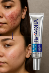 BioAQUA | Acne & Blackhead removal cream